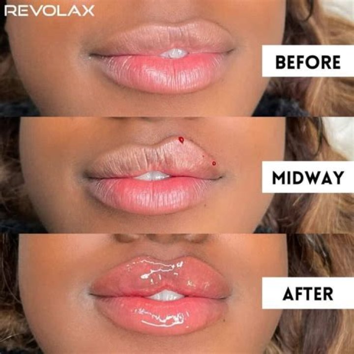 A Deep Dive Into Lip Fillers