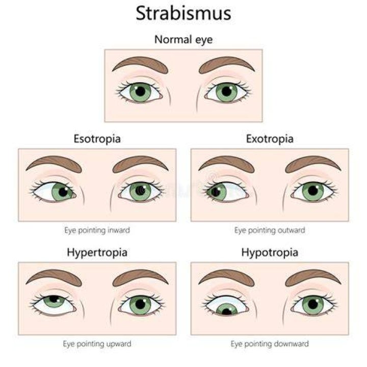 A Revolutionary Solution For Esotropia
