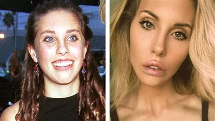 Chloe Lattanzi's Plastic Surgery Journey