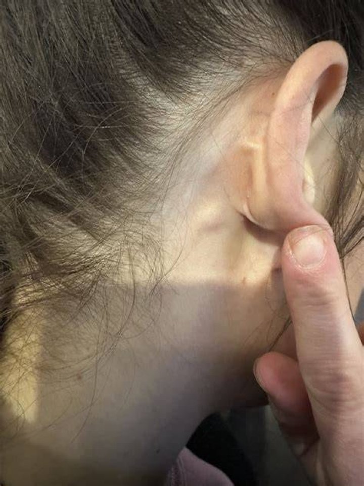 Cillian Murphy's Lump Behind The Ear