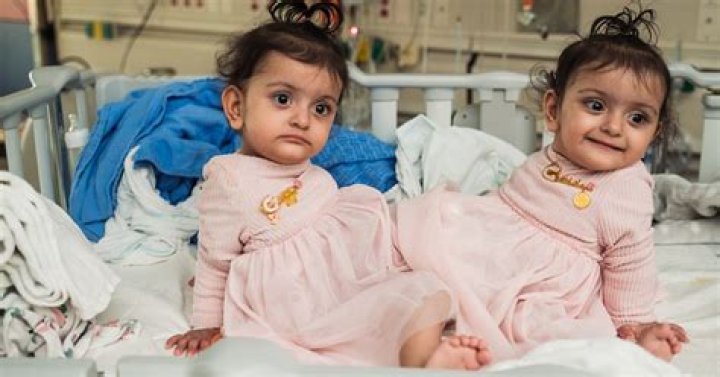 Conjoined Twins: Pregnancy, Delivery & Separation