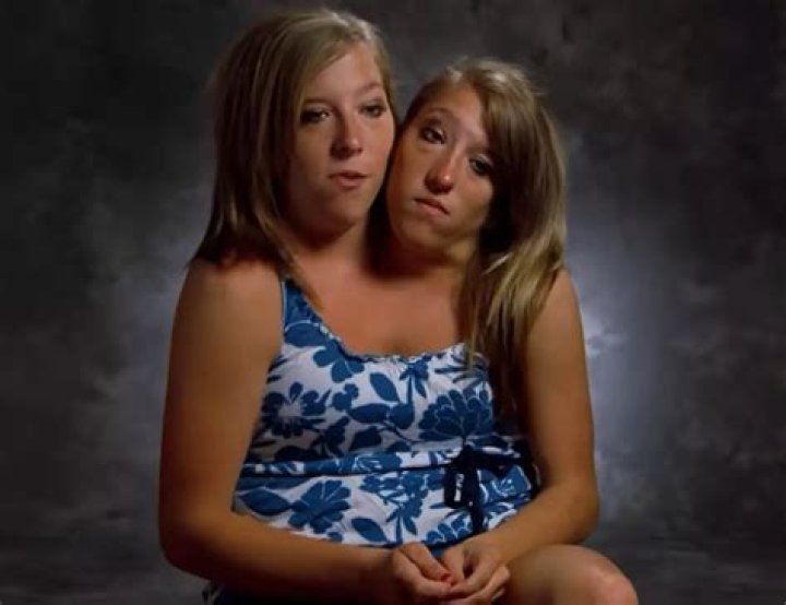 Conjoined Twins Who Defy Odds