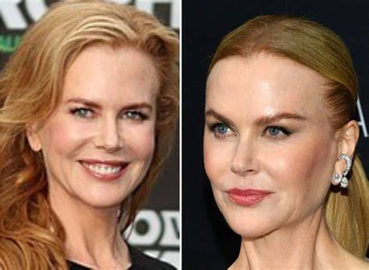 Decoding The Truth: Does Nicole Kidman Have Breast Implants?