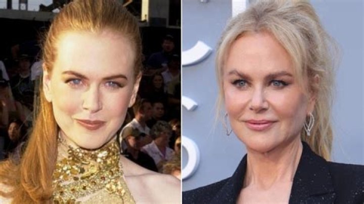 Discover Nicole Kidman's Facelift Journey: A Transformation Unveiled