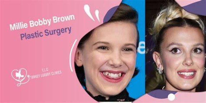 Discover The Secrets Of "Millie Bobby Brown Lip Filler": Insights And Transformations