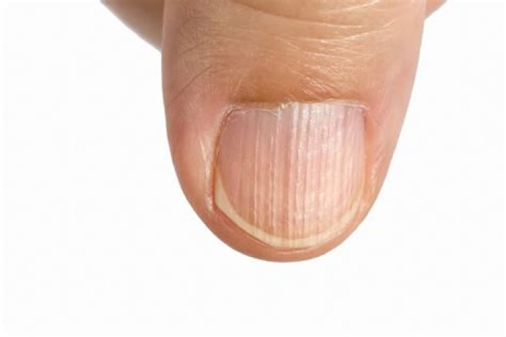 Do Vertical Nail Ridges Indicate Deficiency?