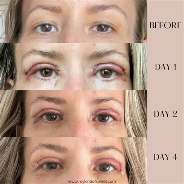Emily Simpson Eye Surgery: Recovery, Results, And More