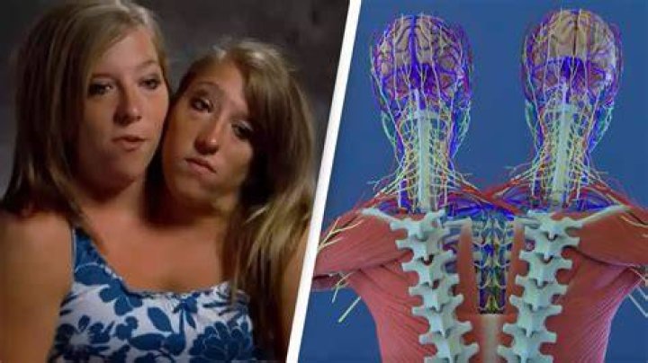 Exploring The Fascinating Anatomy Of Conjoined Twins Abby And Brittany