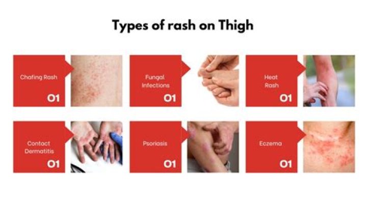 Inner Thigh Rash: Causes, Treatments & Prevention