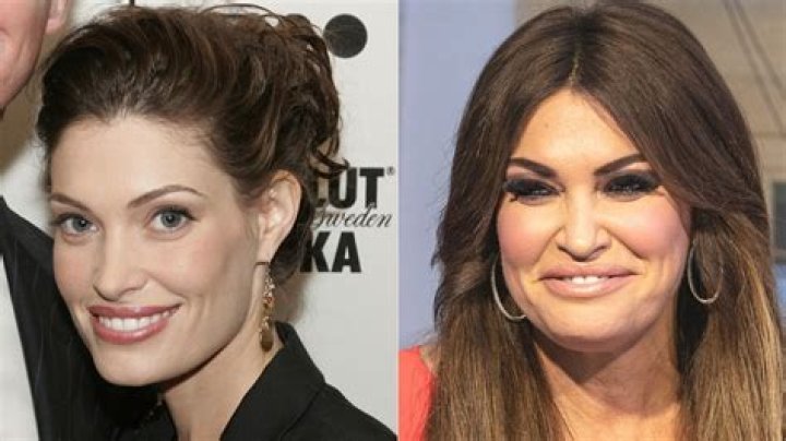 Kimberly Guilfoyle's Face Surgery: The Transformation Revealed