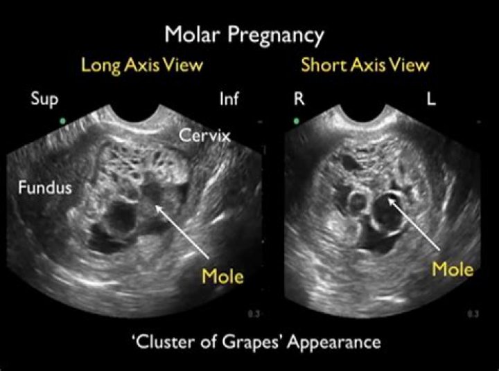 Lisa Nandy's Pregnancy And Its Implications