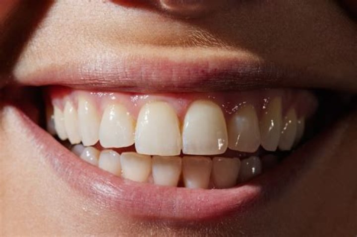 Lorenzo Zurzolo's Perfect Smile: A Comprehensive Look At His Teeth
