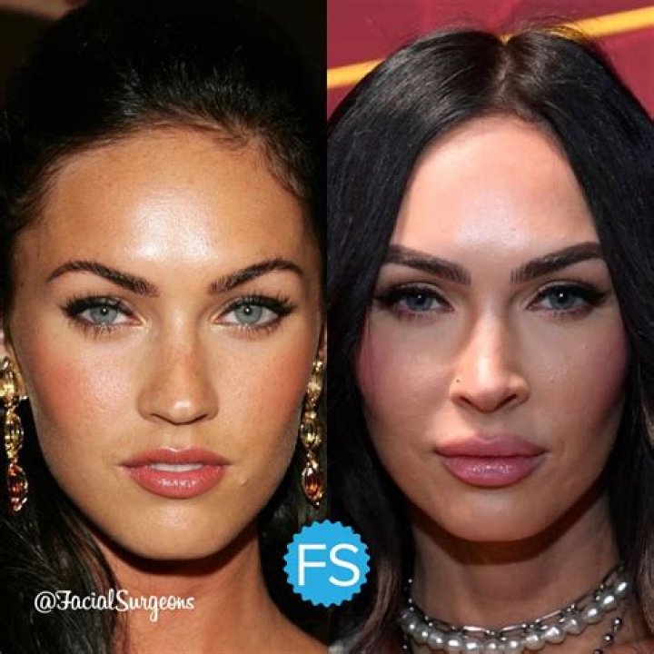 Megan Fox's Plastic Surgery Journey