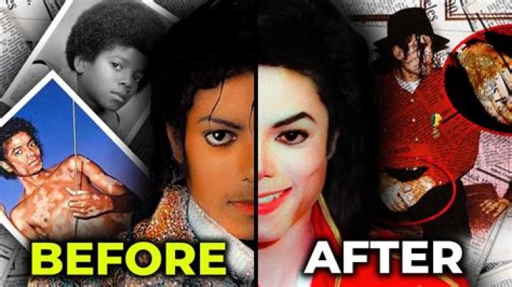 Michael Jackson's Vitiligo: Truth & Legacy