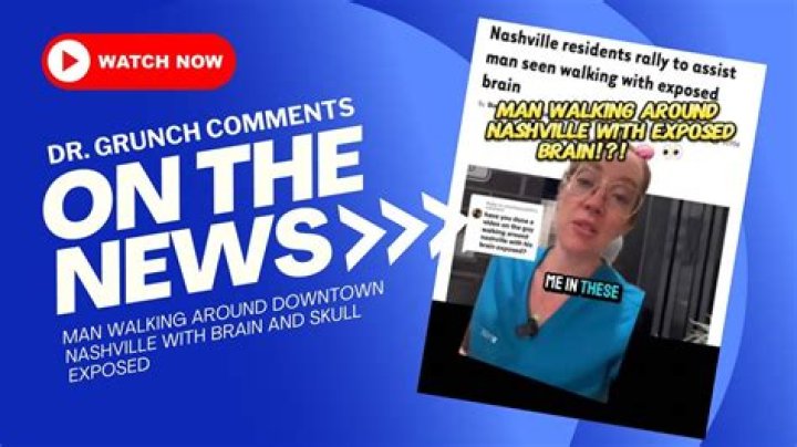 Nashville Man Walks Around With Exposed Brain
