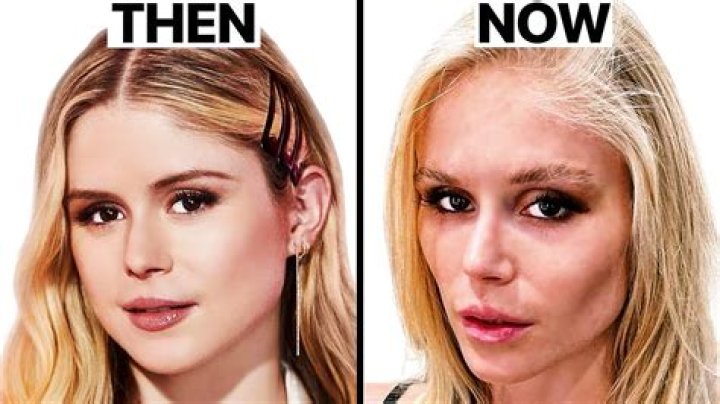 Suki Waterhouse's Plastic Surgery Journey Unveiled