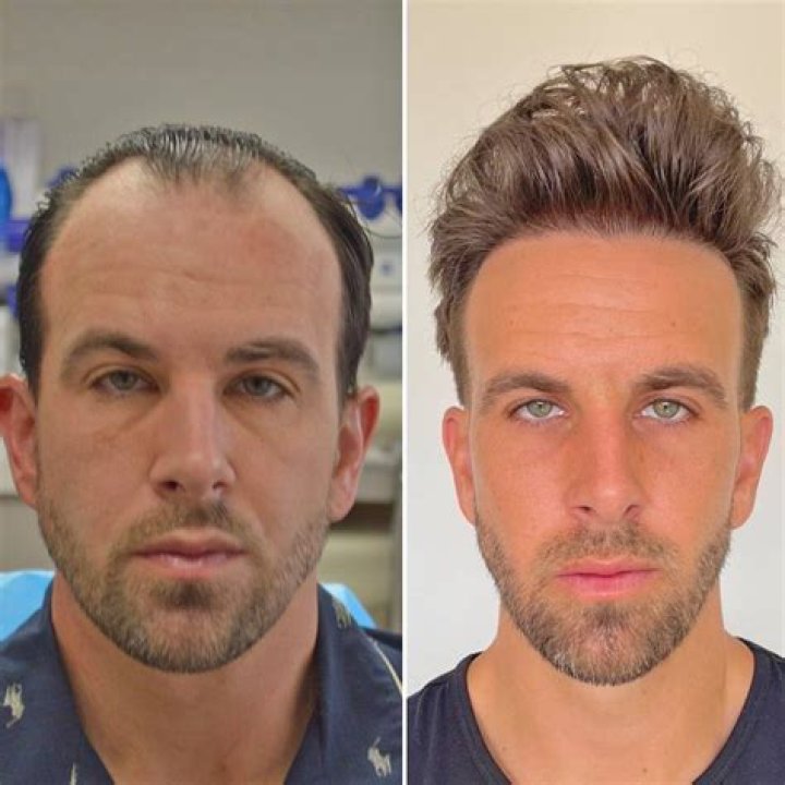 The Transformative Journey Of Zaid Garcia's Face Transplant
