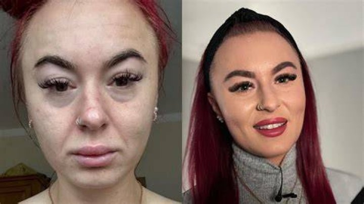 Transformation Unveiled: Sabrina's Journey Before And After Surgery