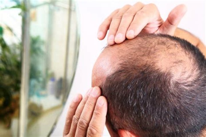 Understand The Causes Behind David Dobrik's Sudden Hair Loss