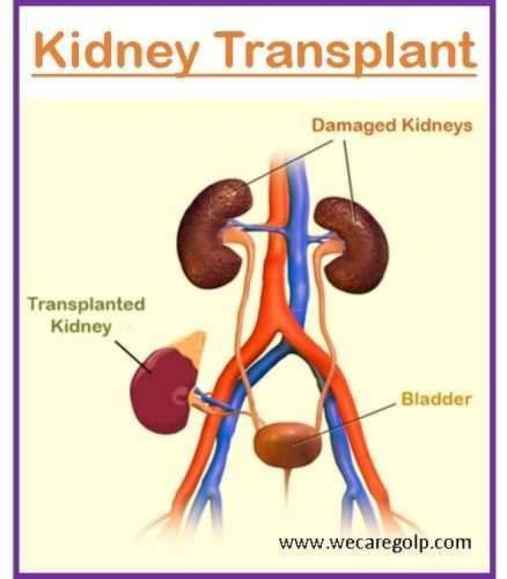 Understanding The Journey Of Kidney Transplant Scars