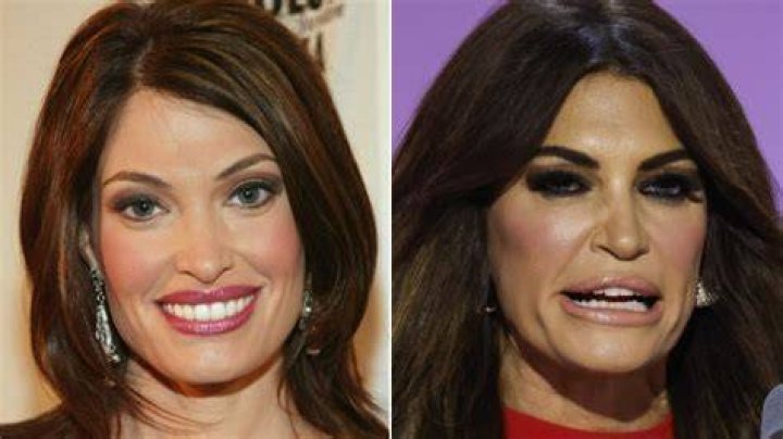 Unraveling The Mystery: What Is Wrong With Kimberly Guilfoyle's Face?