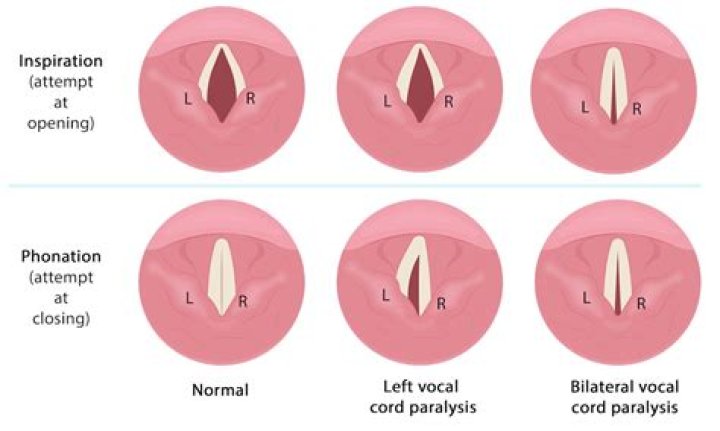 Unveiling Brandy Renee's Pre-Surgery Vocal Prowess: Discoveries And Insights