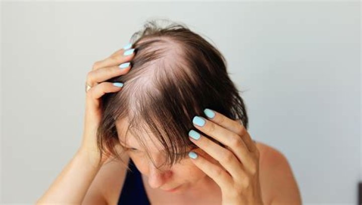 Unveiling The Empowering World Of Celebrity Women Embracing Baldness For A Thriving Society