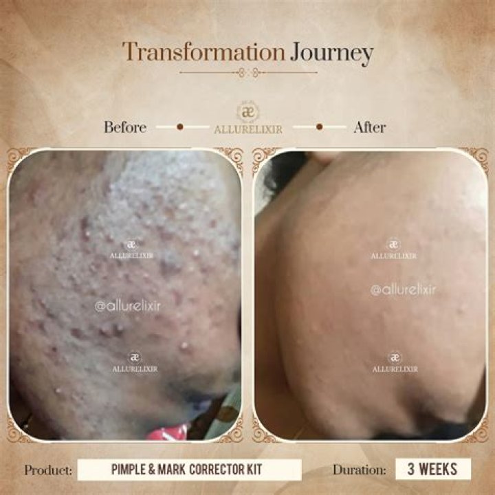 Unveiling The Truth: Beyonce's Skin Transformation Journey